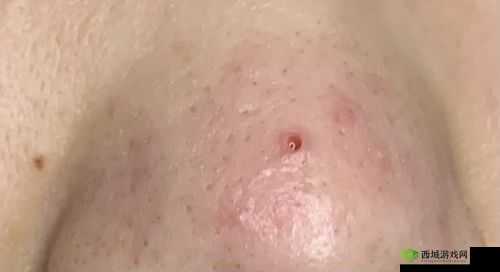 粗大黑头紫大黑头紫挤进:一个奇特现象