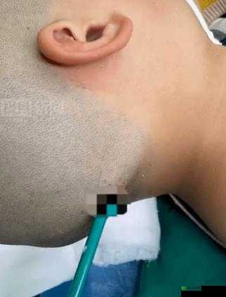 12 岁∶笔塞异物