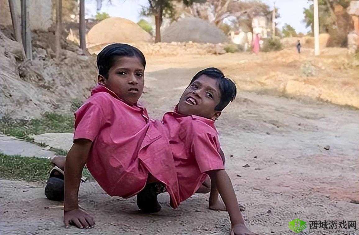 神奇的共生双胞胎：共享身体，共享人生