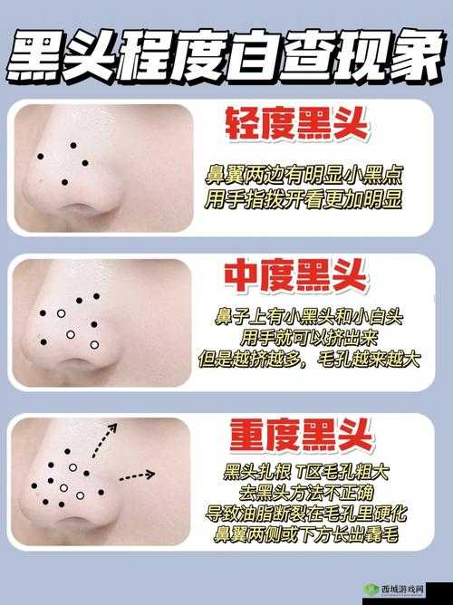 粗大黑头紫大黑头紫挤进：一场奇异的现象