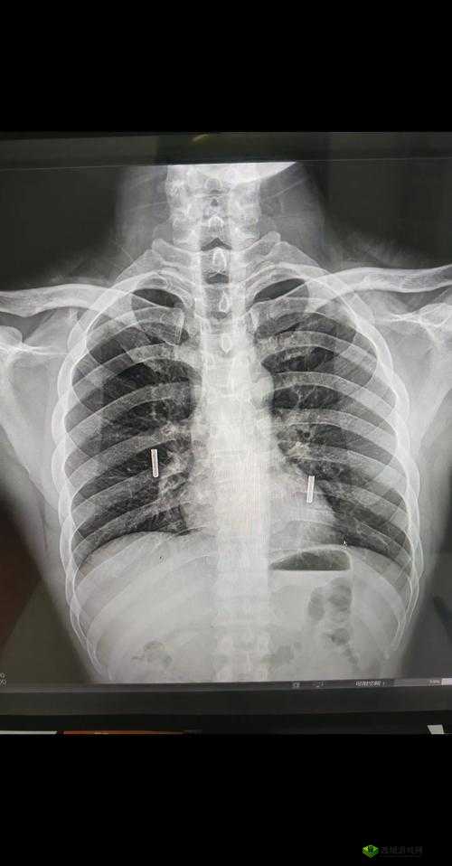 十大曝光胸片,揭示不为人知的真相