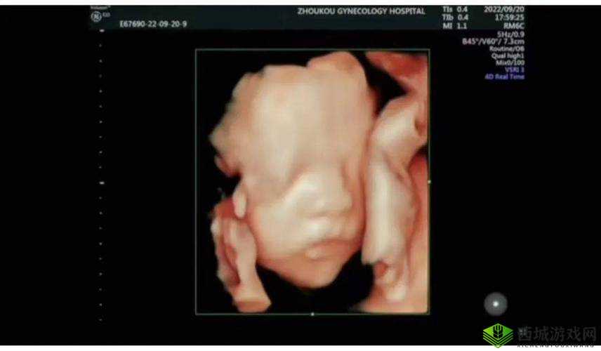 为什么 B 超医生会问有没有做四维?这背后的原因究竟是什么?