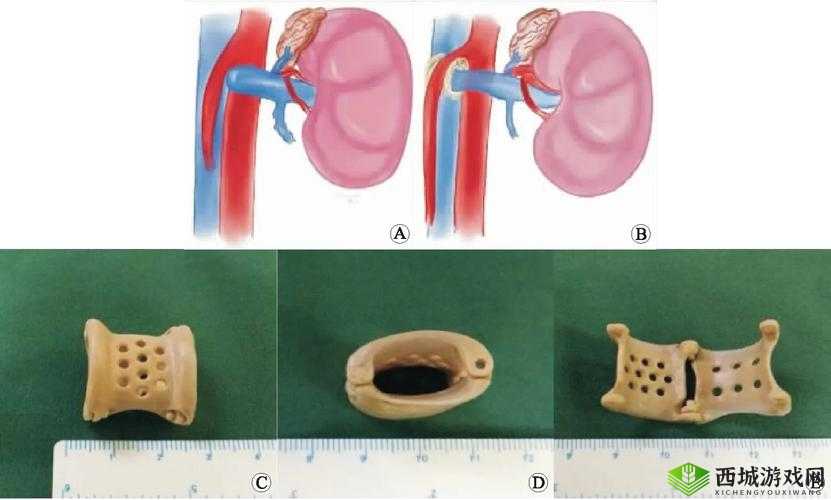 胡桃夹手术后是否需要终身服药?专家解答与术后护理指南